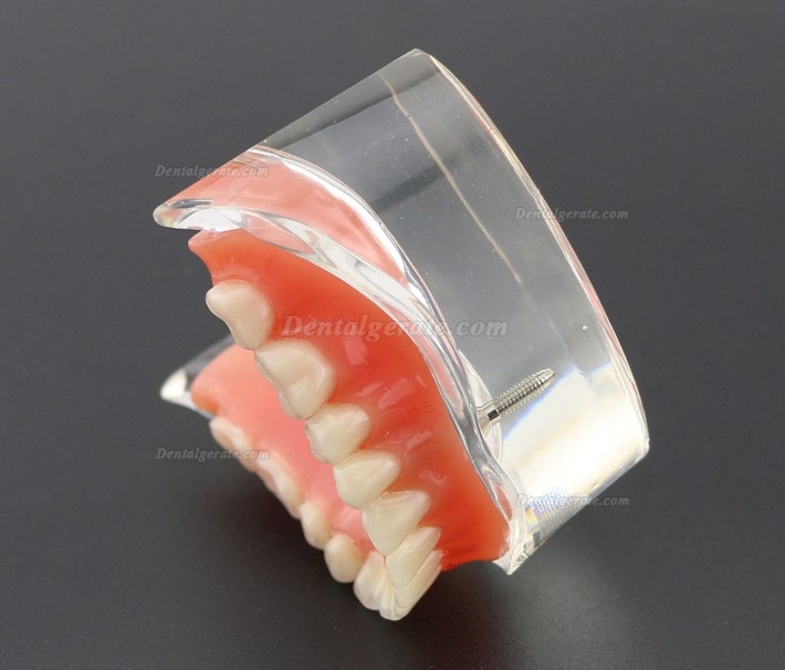 Modell f&uuml;r zahn&auml;rztliche Oberz&auml;hne Overdenture Superior 4 Implantate Demo Modell 6001 02